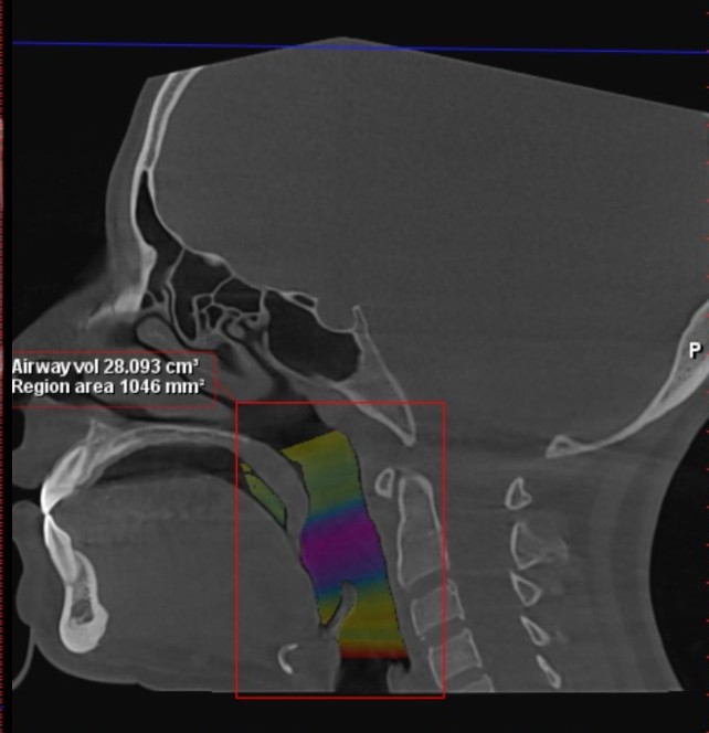 Airway volume reconstructed on 3D CBCT, after, measured at 28.00 cubic centimeters
