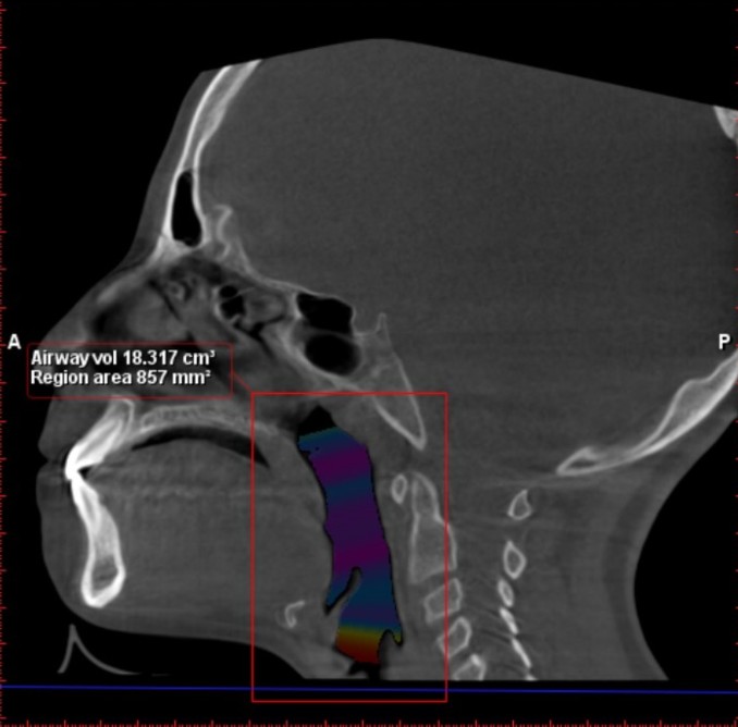 Airway volume reconstructed on 3D CBCT, before, measured at 18.32 cubic centimeters