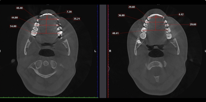 De-identified axial CBCT showing upper-arch width measurements before and after redevelopment