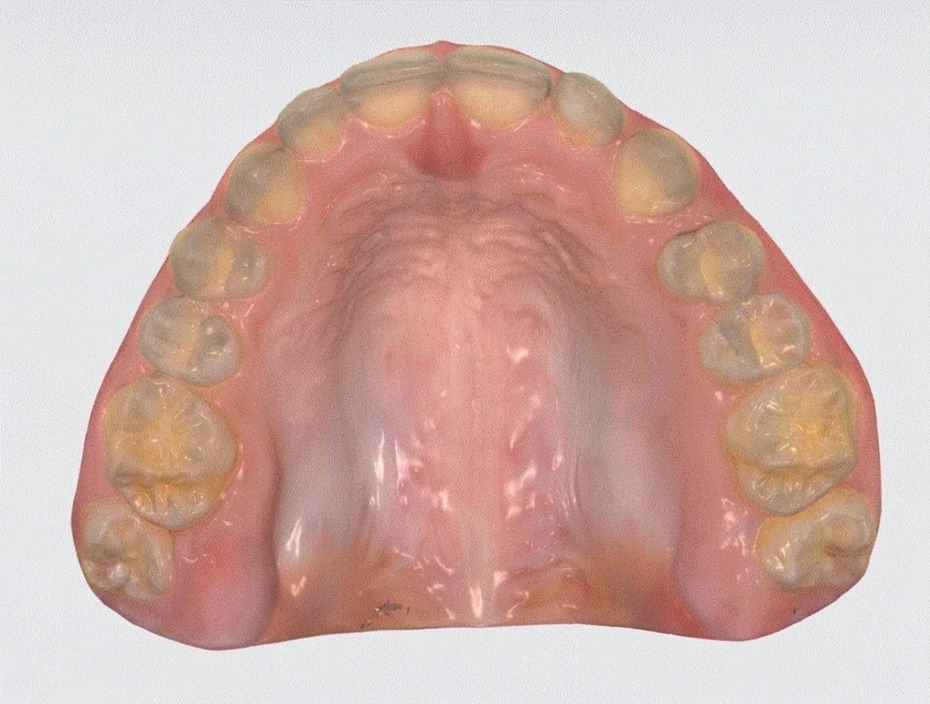 Upper dental arch on a 3D intraoral scan, after redevelopment, a wider palate